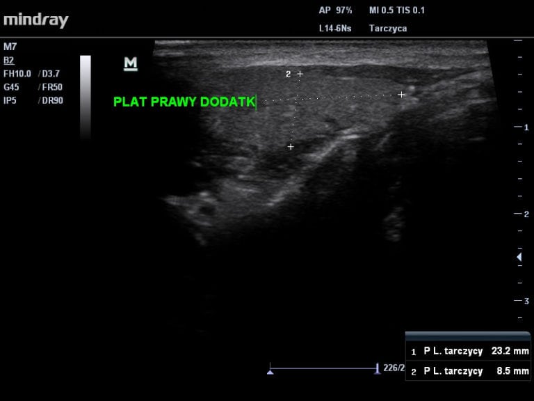 Dodatkowy Płat Tarczycy Jacek Sieredziński Usg Piersi Tarczycy Jamy Brzusznej Szczecin 2568