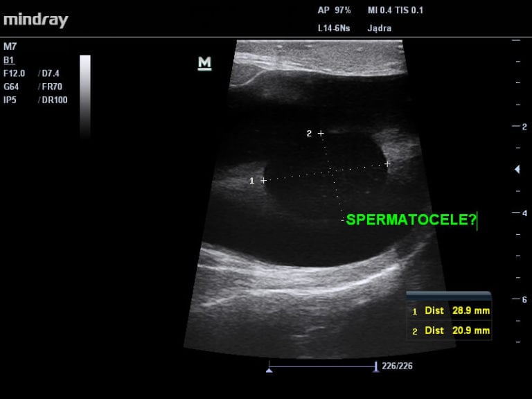 Spermatocele Jacek Sieredziński Usg Piersi Tarczycy Jamy Brzusznej Szczecin Police